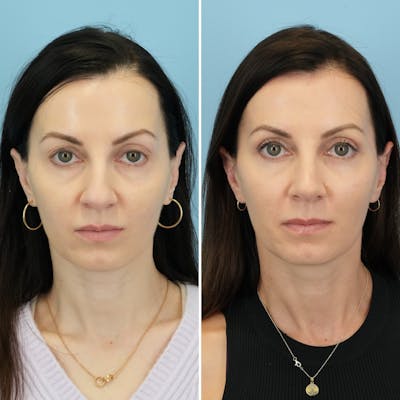 Rhinoplasty Before & After Gallery - Patient 285654 - Image 4