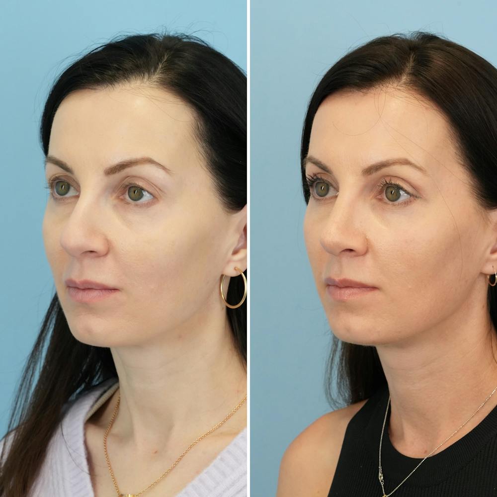 Rhinoplasty Before & After Gallery - Patient 285654 - Image 5