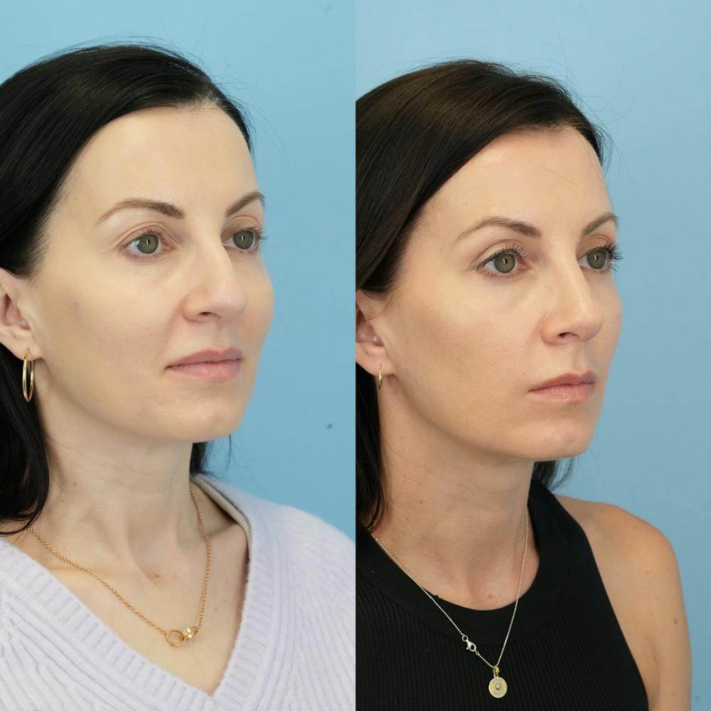 Rhinoplasty Before & After Gallery - Patient 285654 - Image 3