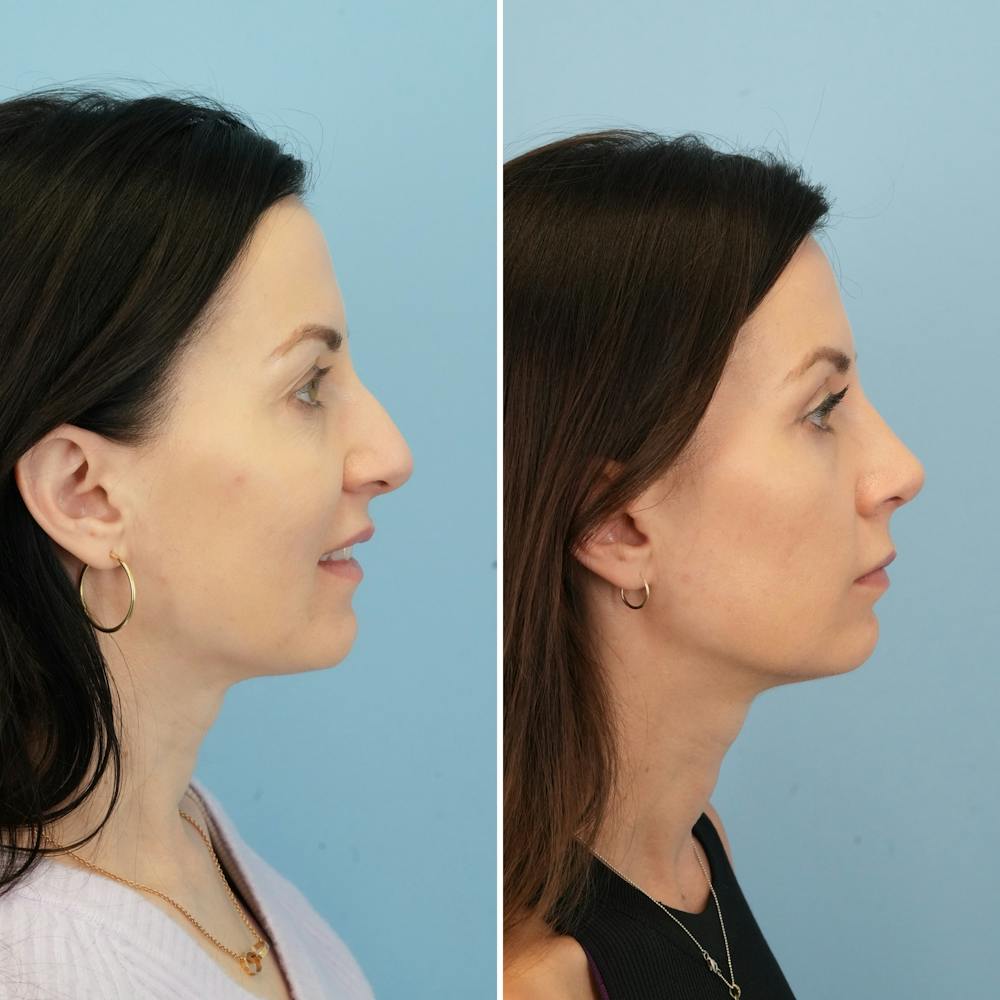 Rhinoplasty Before & After Gallery - Patient 285654 - Image 1