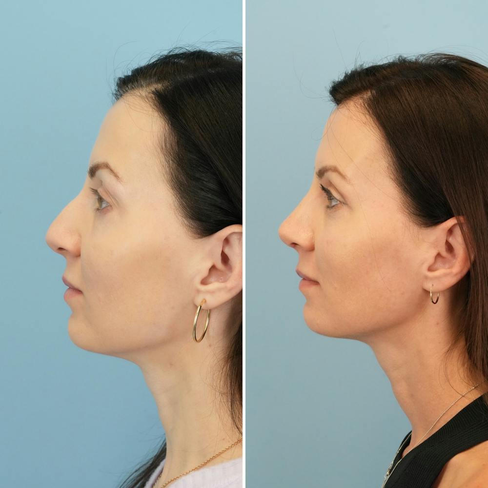 Rhinoplasty Before & After Gallery - Patient 285654 - Image 7