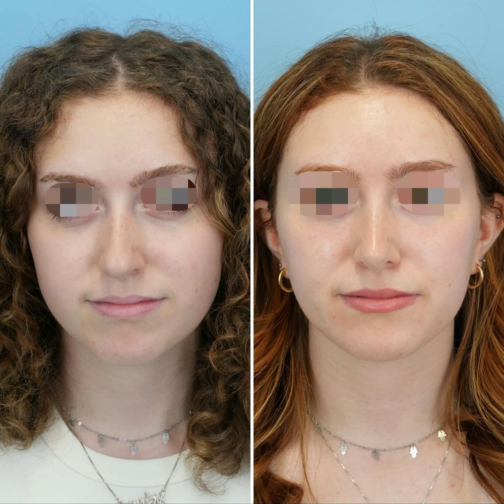 Rhinoplasty Before & After Gallery - Patient 415394 - Image 4