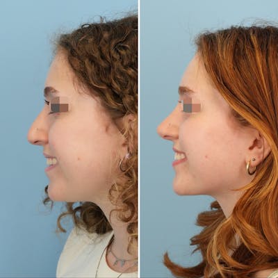 Rhinoplasty Before & After Gallery - Patient 415394 - Image 6