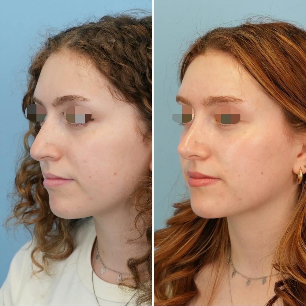 Rhinoplasty Before & After Gallery - Patient 415394 - Image 5
