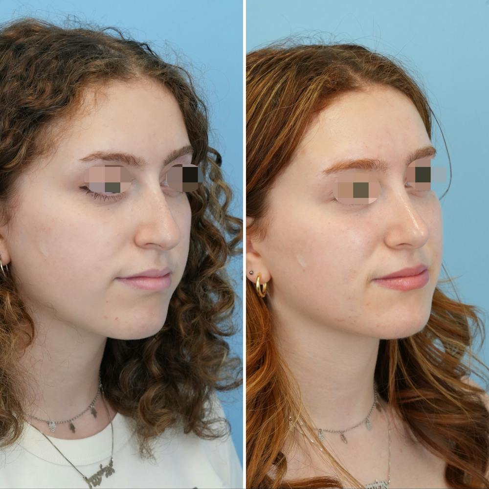 Rhinoplasty Before & After Gallery - Patient 415394 - Image 3