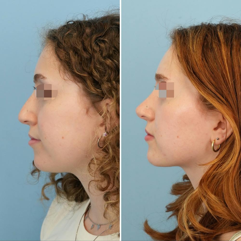 Rhinoplasty Before & After Gallery - Patient 415394 - Image 7