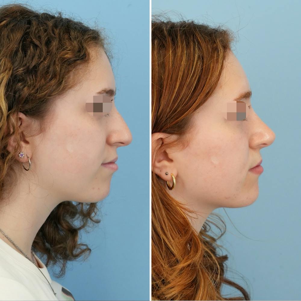 Rhinoplasty Before & After Gallery - Patient 415394 - Image 1