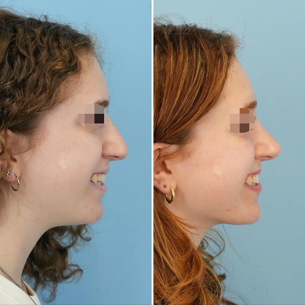 Rhinoplasty Before & After Gallery - Patient 415394 - Image 2