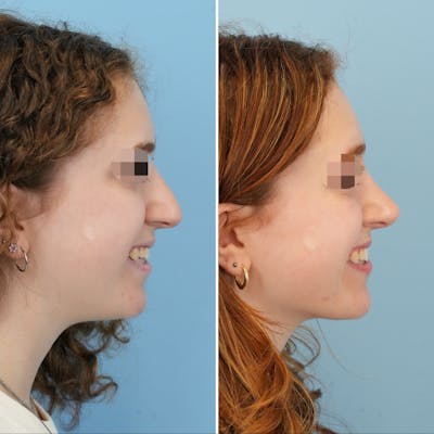 Rhinoplasty Before & After Gallery - Patient 415394 - Image 2