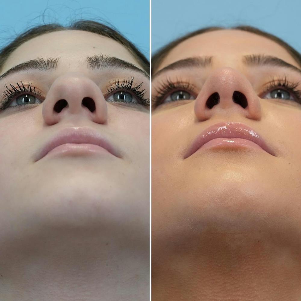 Rhinoplasty Before & After Gallery - Patient 196516 - Image 6