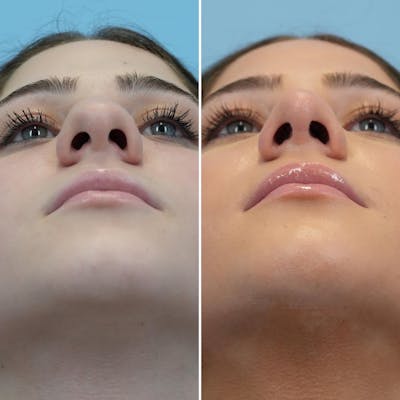 Rhinoplasty Before & After Gallery - Patient 196516 - Image 6