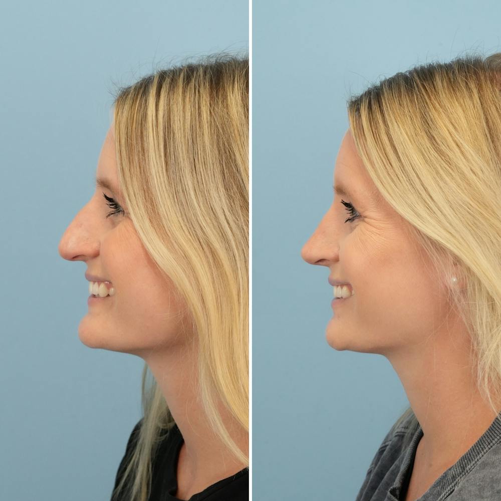 Rhinoplasty Before & After Gallery - Patient 189567 - Image 4