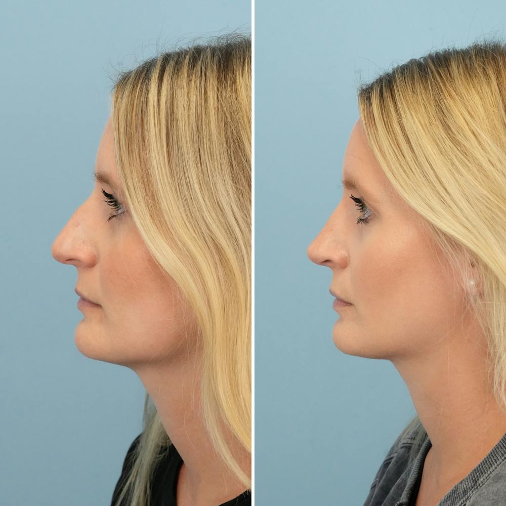 Rhinoplasty Before & After Gallery - Patient 189567 - Image 5