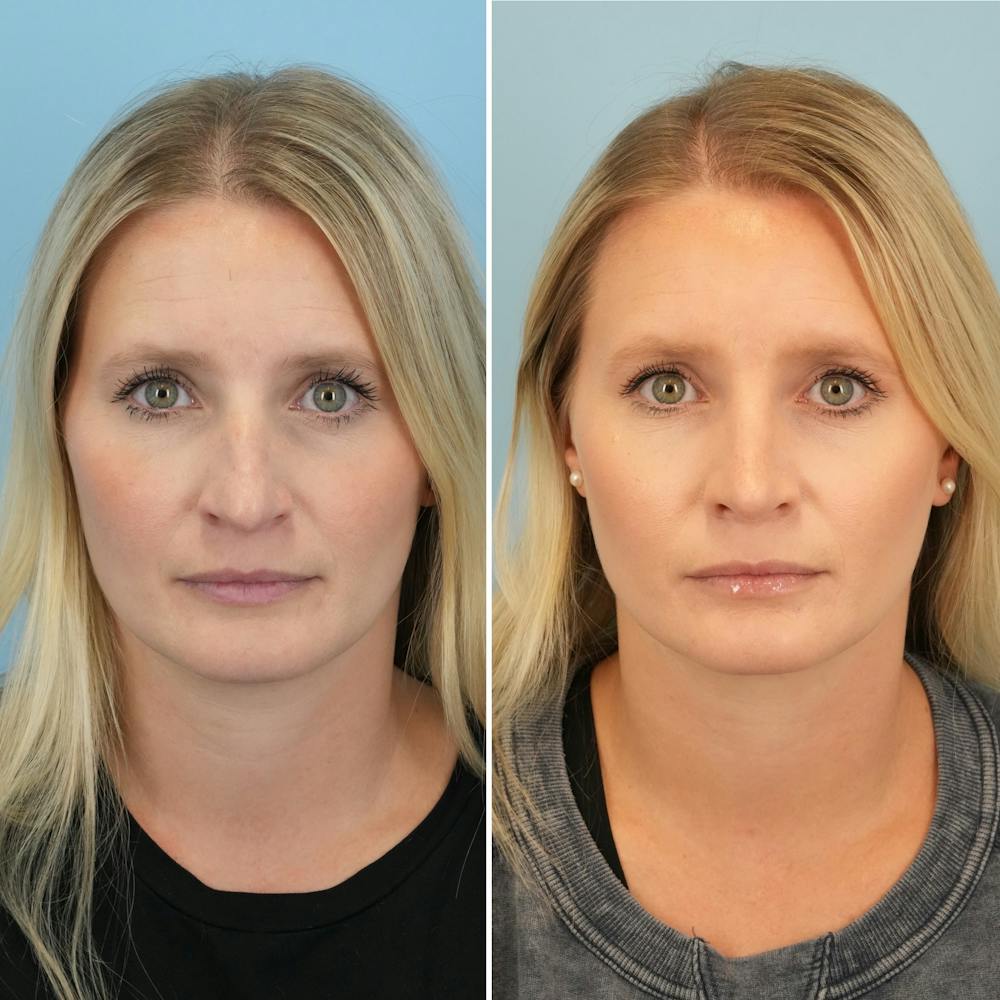 Rhinoplasty Before & After Gallery - Patient 189567 - Image 3