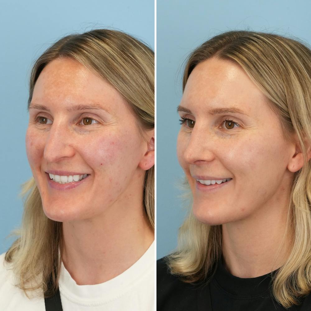 Rhinoplasty Before & After Gallery - Patient 239104 - Image 6