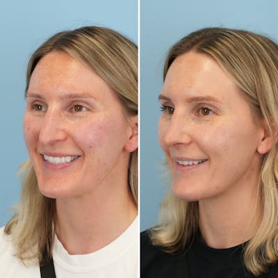 Rhinoplasty Before & After Gallery - Patient 239104 - Image 6
