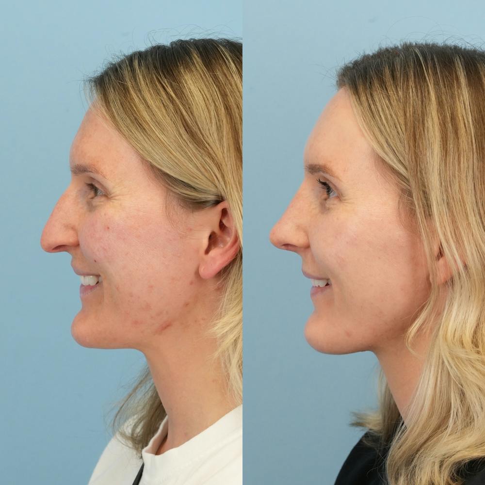 Rhinoplasty Before & After Gallery - Patient 239104 - Image 8