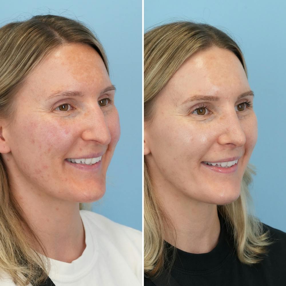 Rhinoplasty Before & After Gallery - Patient 239104 - Image 4