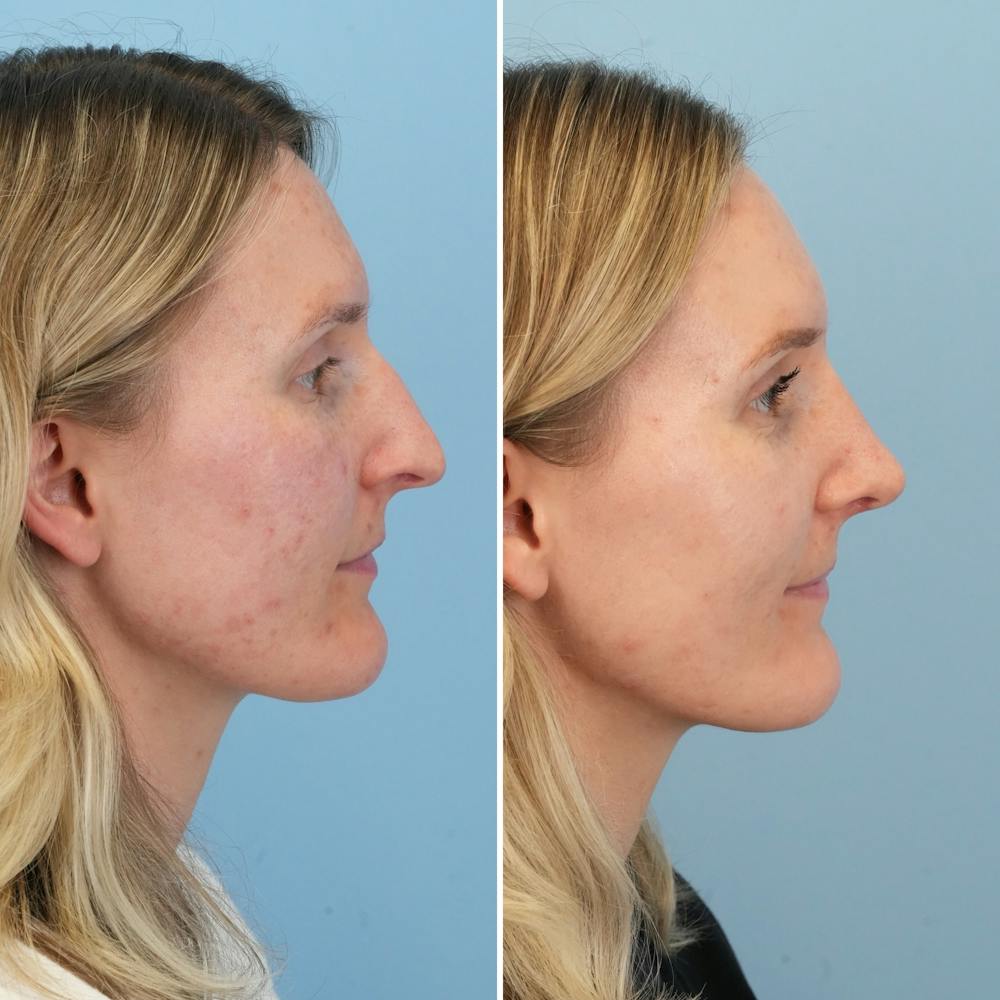 Rhinoplasty Before & After Gallery - Patient 239104 - Image 1