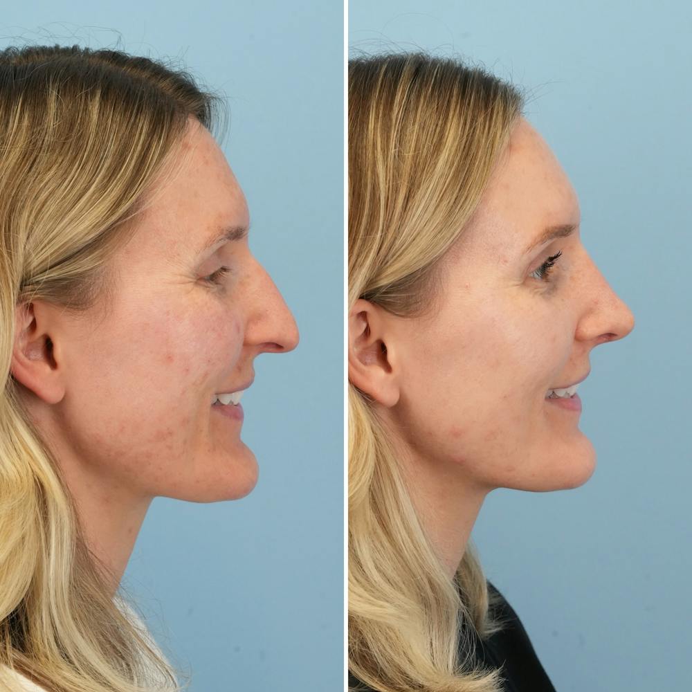 Rhinoplasty Before & After Gallery - Patient 239104 - Image 2