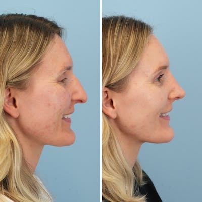 Rhinoplasty Before & After Gallery - Patient 239104 - Image 2