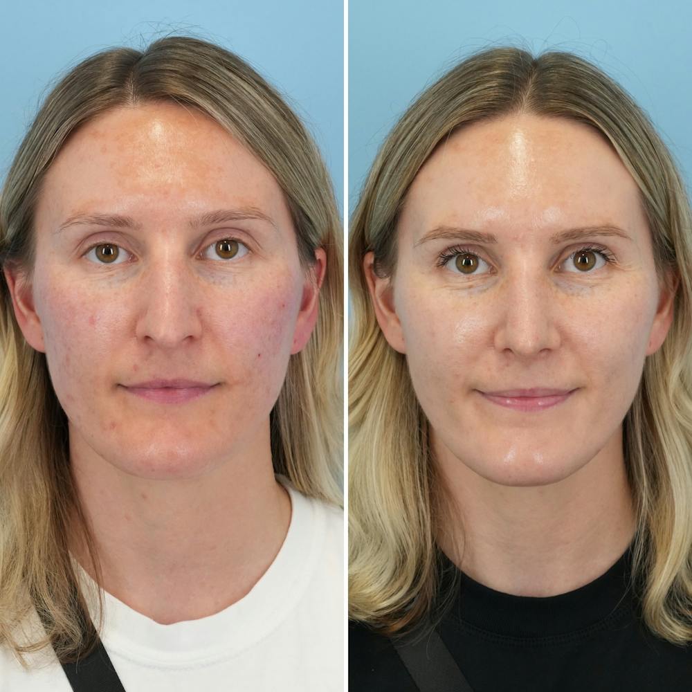 Rhinoplasty Before & After Gallery - Patient 239104 - Image 5