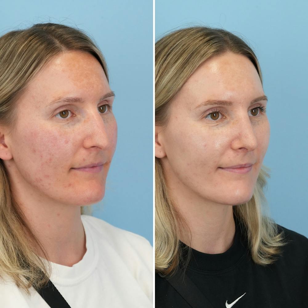 Rhinoplasty Before & After Gallery - Patient 239104 - Image 3