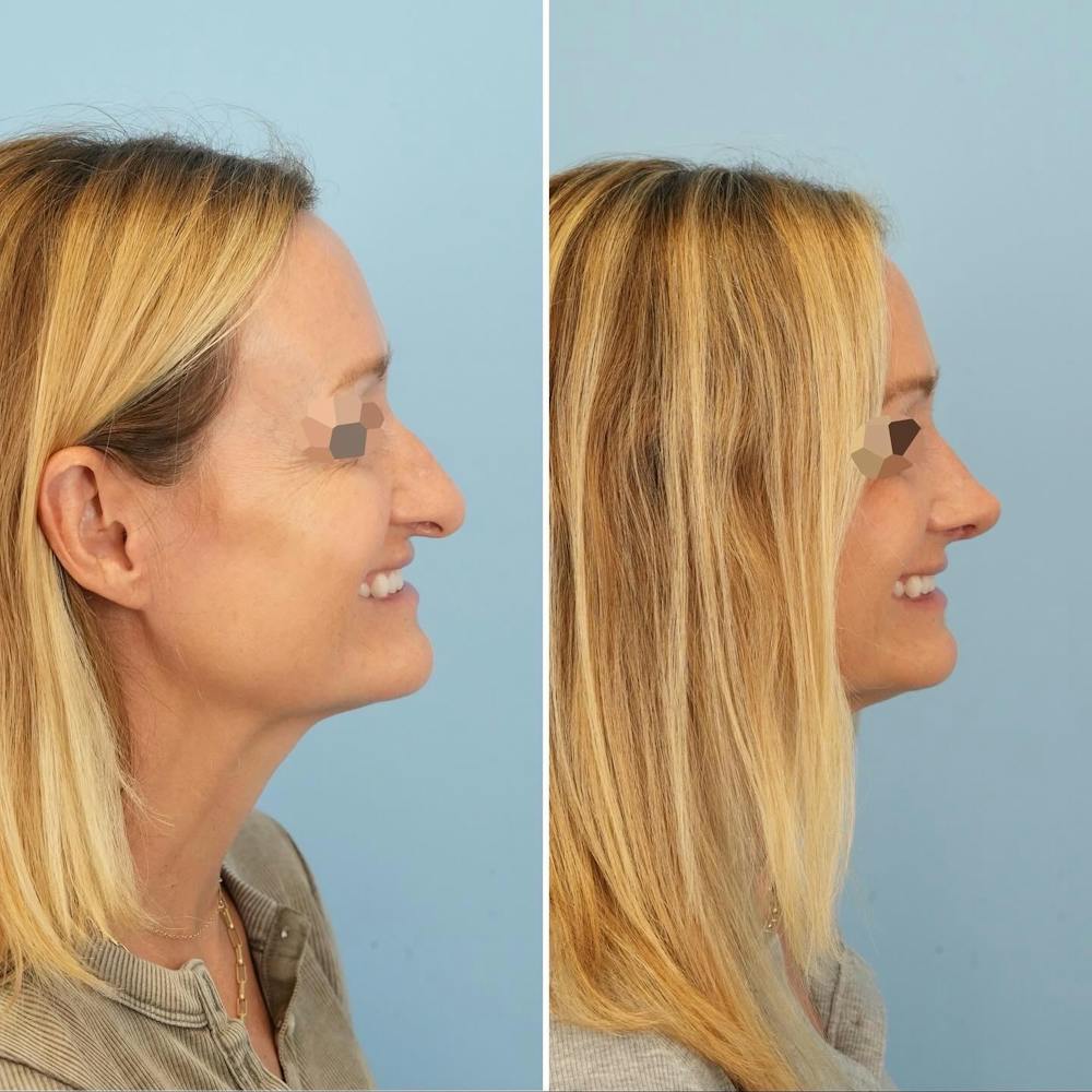 Rhinoplasty Before & After Gallery - Patient 126062 - Image 2