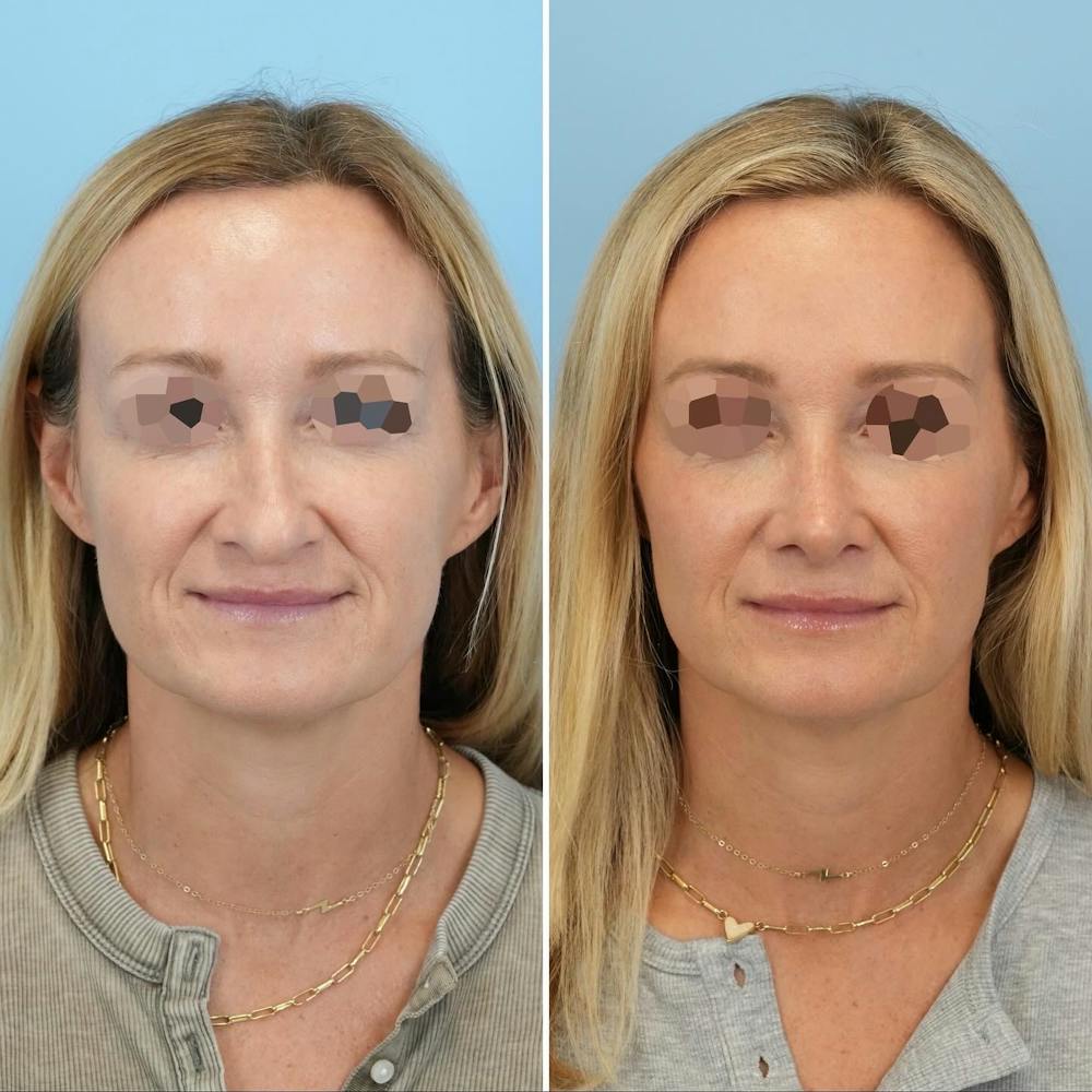 Rhinoplasty Before & After Gallery - Patient 126062 - Image 4