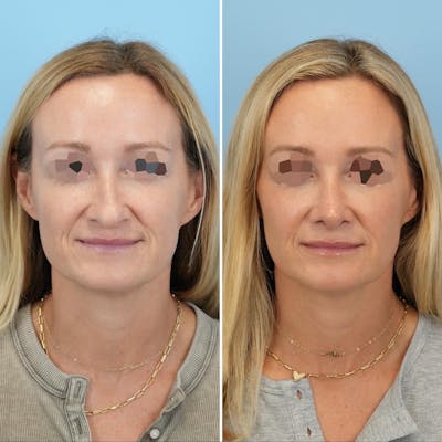 Rhinoplasty Before & After Gallery - Patient 126062 - Image 4