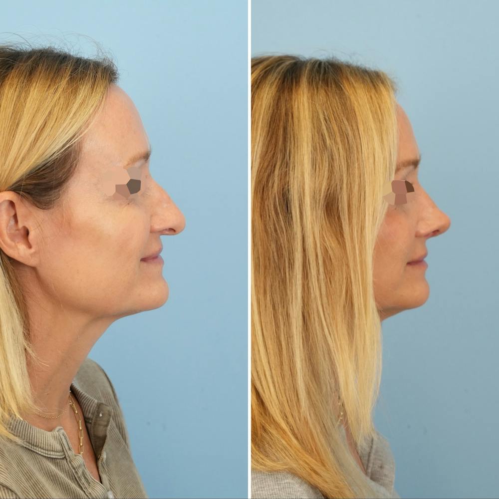 Rhinoplasty Before & After Gallery - Patient 126062 - Image 1