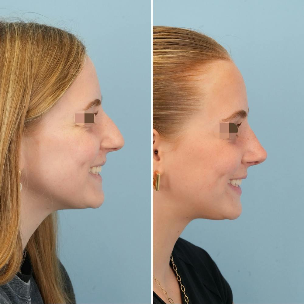 Rhinoplasty Before & After Gallery - Patient 227716 - Image 2