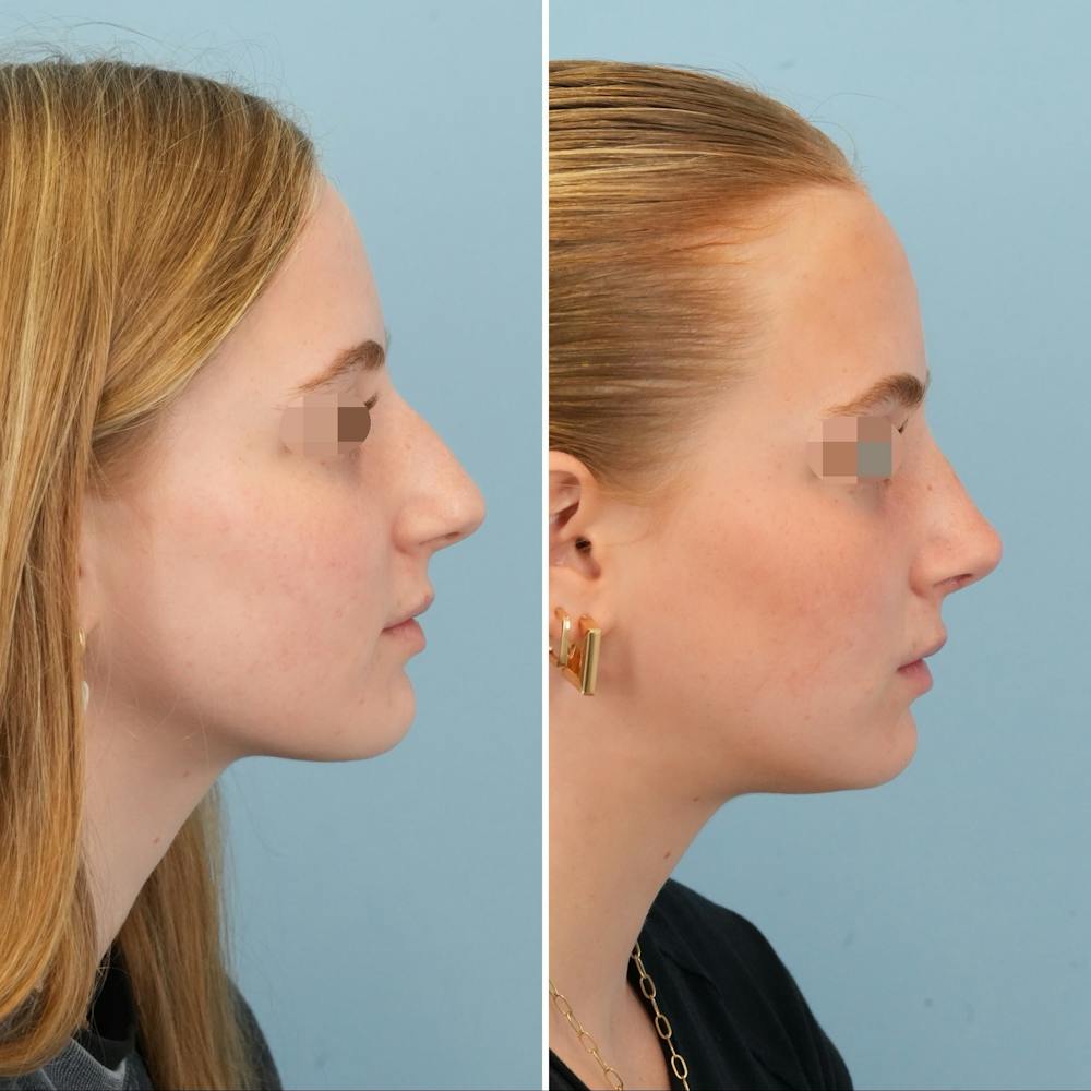 Rhinoplasty Before & After Gallery - Patient 227716 - Image 1