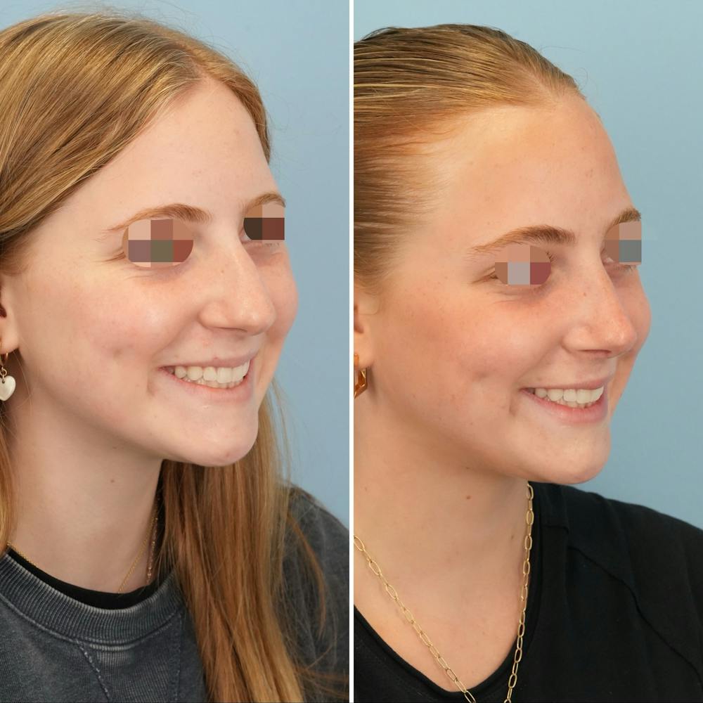 Rhinoplasty Before & After Gallery - Patient 227716 - Image 4