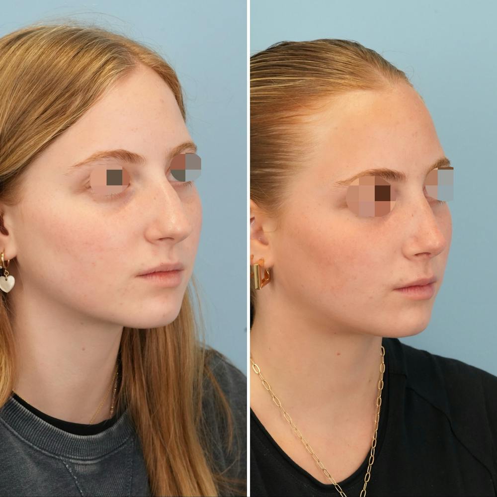 Rhinoplasty Before & After Gallery - Patient 227716 - Image 3