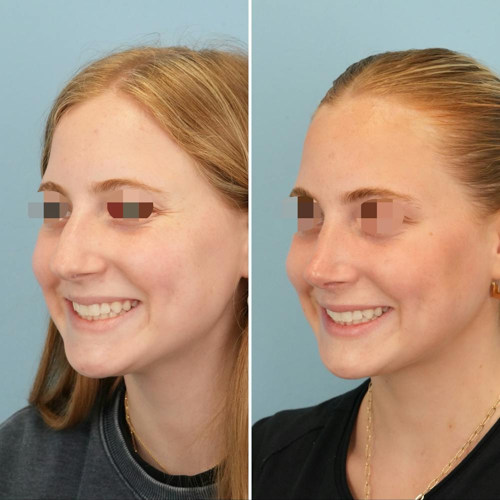 Rhinoplasty Before & After Gallery - Patient 227716 - Image 6