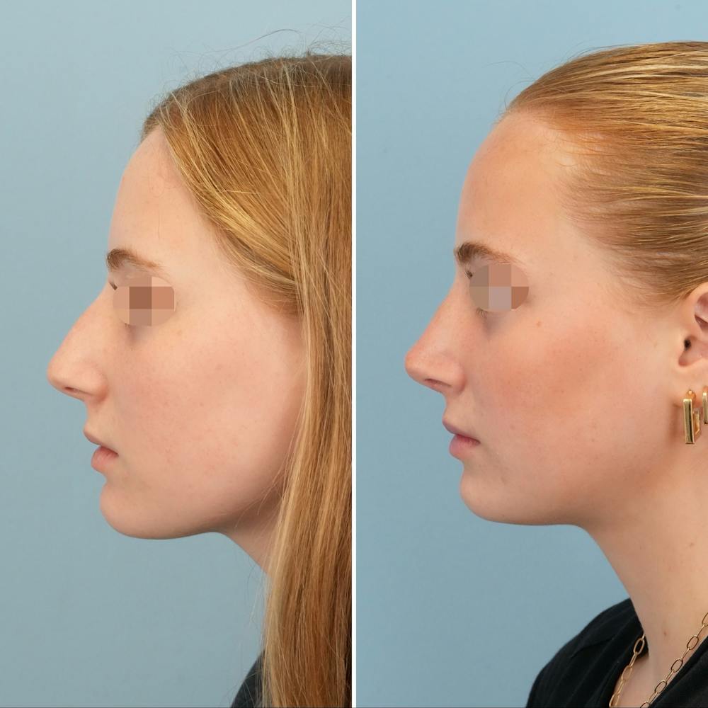 Rhinoplasty Before & After Gallery - Patient 227716 - Image 9