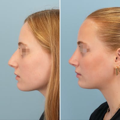 Rhinoplasty Before & After Gallery - Patient 329446 - Image 8