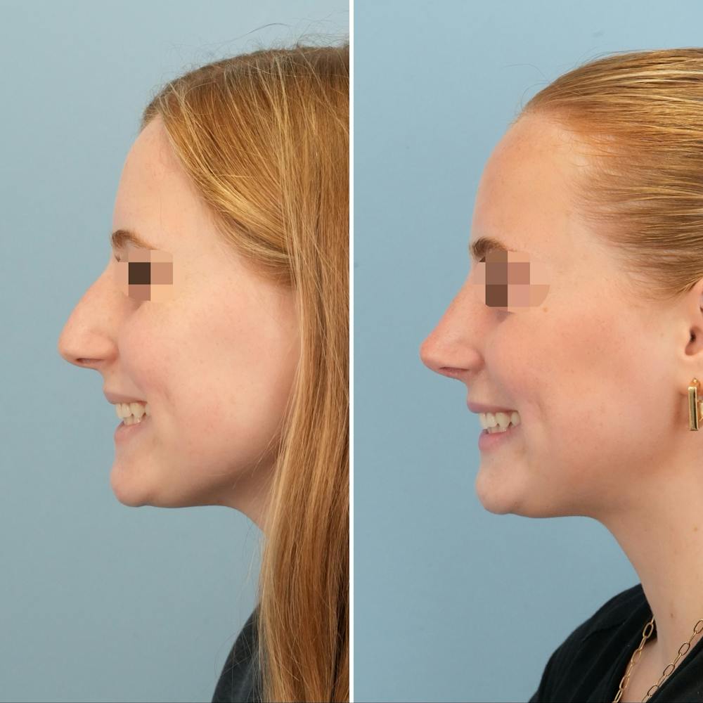 Rhinoplasty Before & After Gallery - Patient 227716 - Image 8