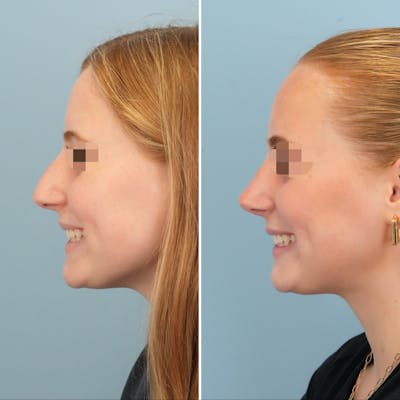 Rhinoplasty Before & After Gallery - Patient 227716 - Image 8