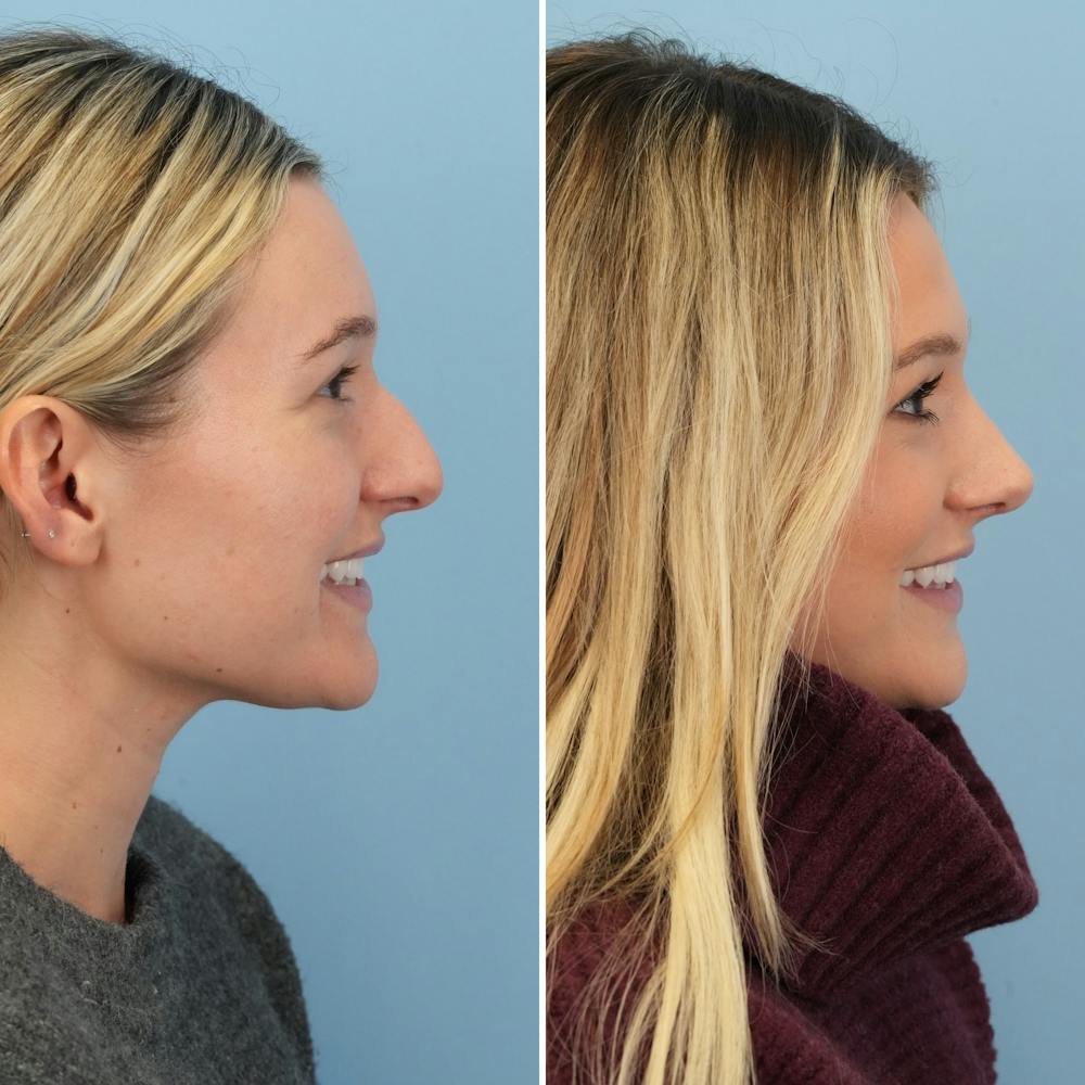 Rhinoplasty Before & After Gallery - Patient 376222 - Image 2