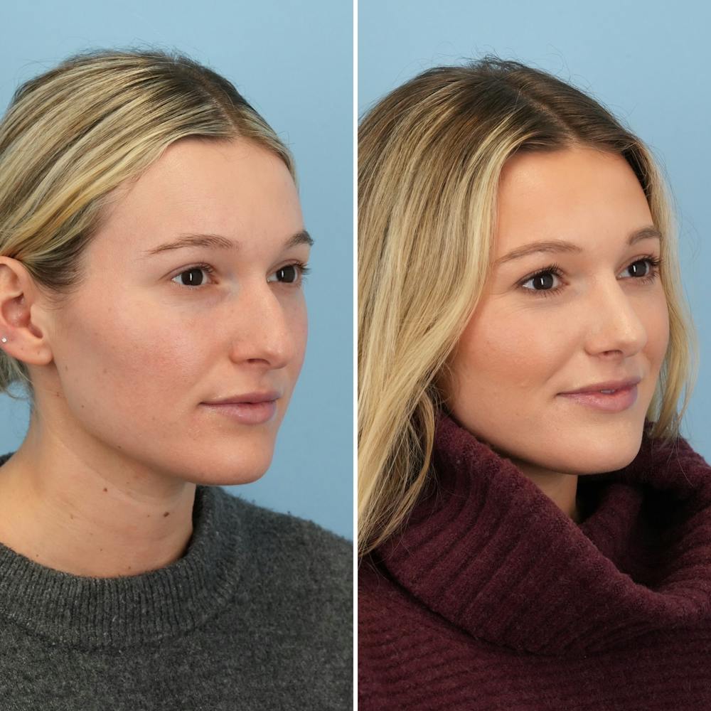 Rhinoplasty Before & After Gallery - Patient 376222 - Image 3