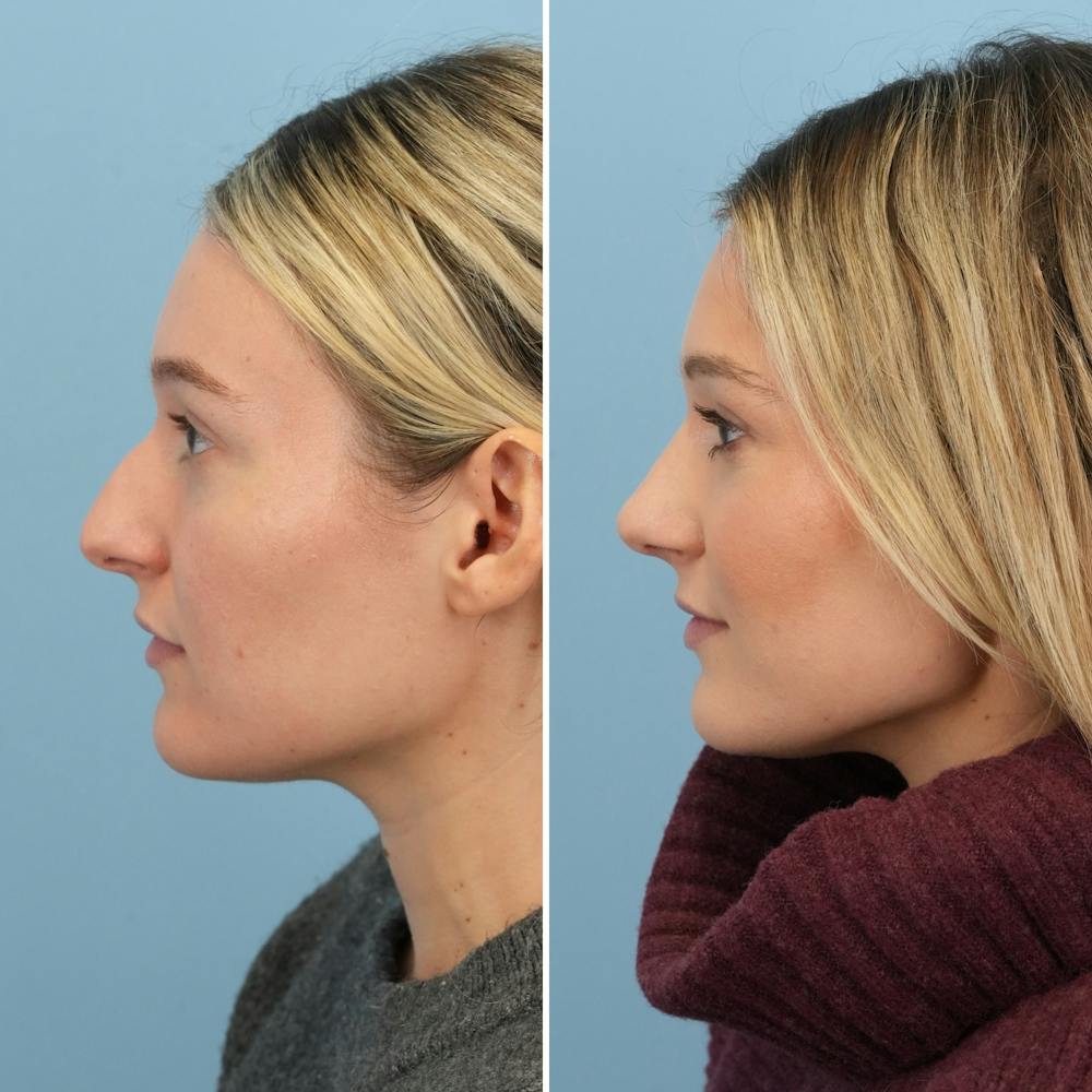 Rhinoplasty Before & After Gallery - Patient 376222 - Image 7