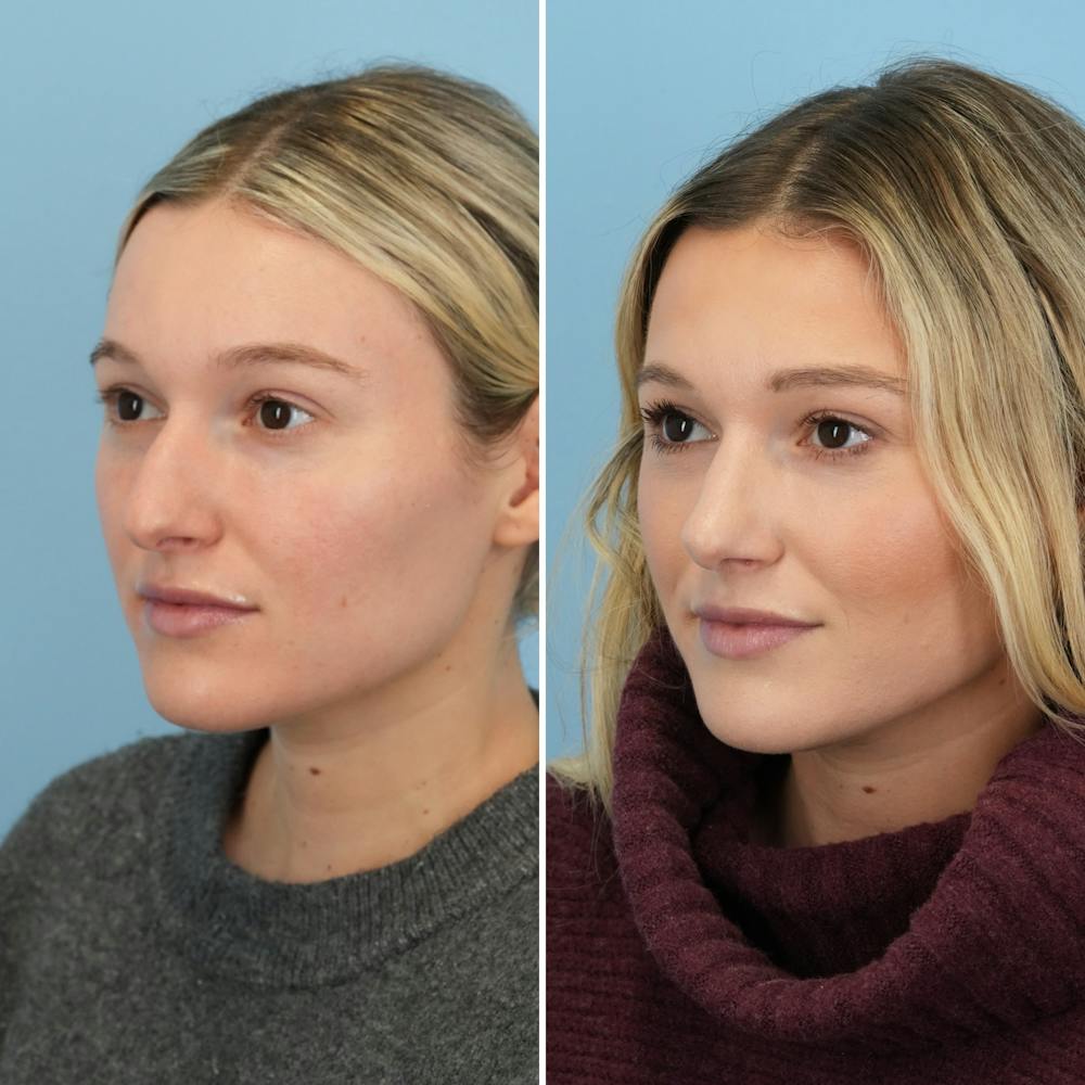 Rhinoplasty Before & After Gallery - Patient 376222 - Image 5