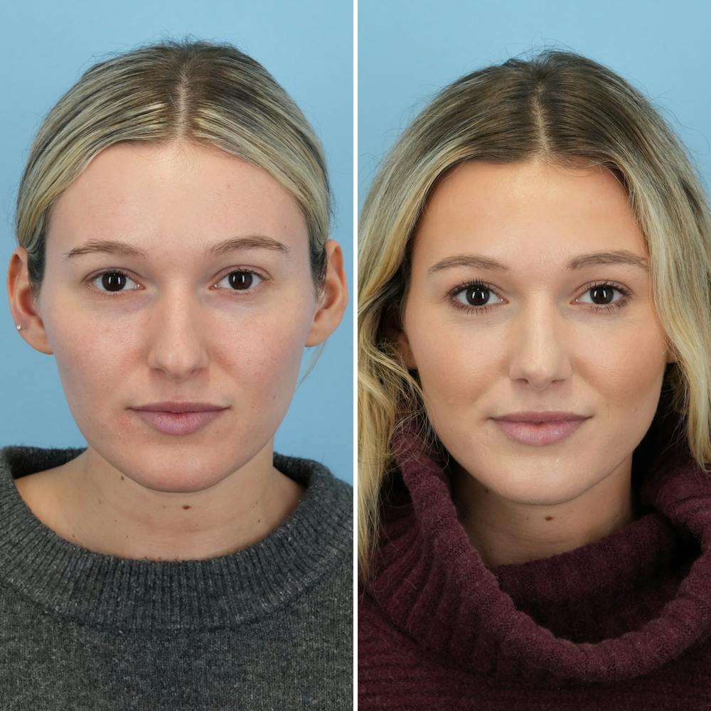 Rhinoplasty Before & After Gallery - Patient 376222 - Image 4
