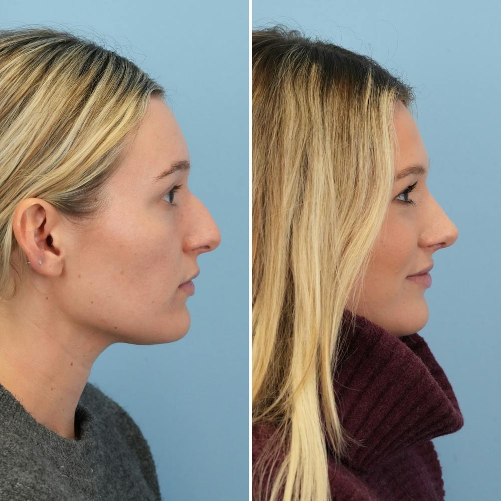 Rhinoplasty Before & After Gallery - Patient 376222 - Image 1