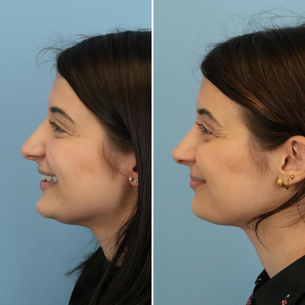 Rhinoplasty Before & After Gallery - Patient 312627 - Image 6