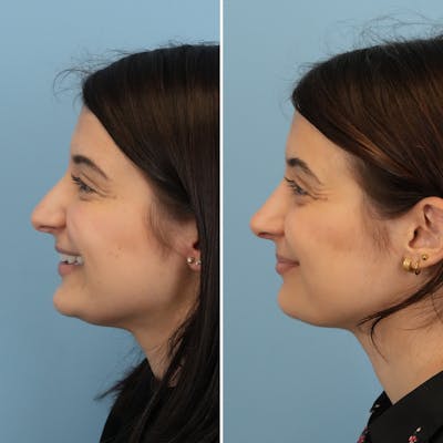 Rhinoplasty Before & After Gallery - Patient 312627 - Image 6