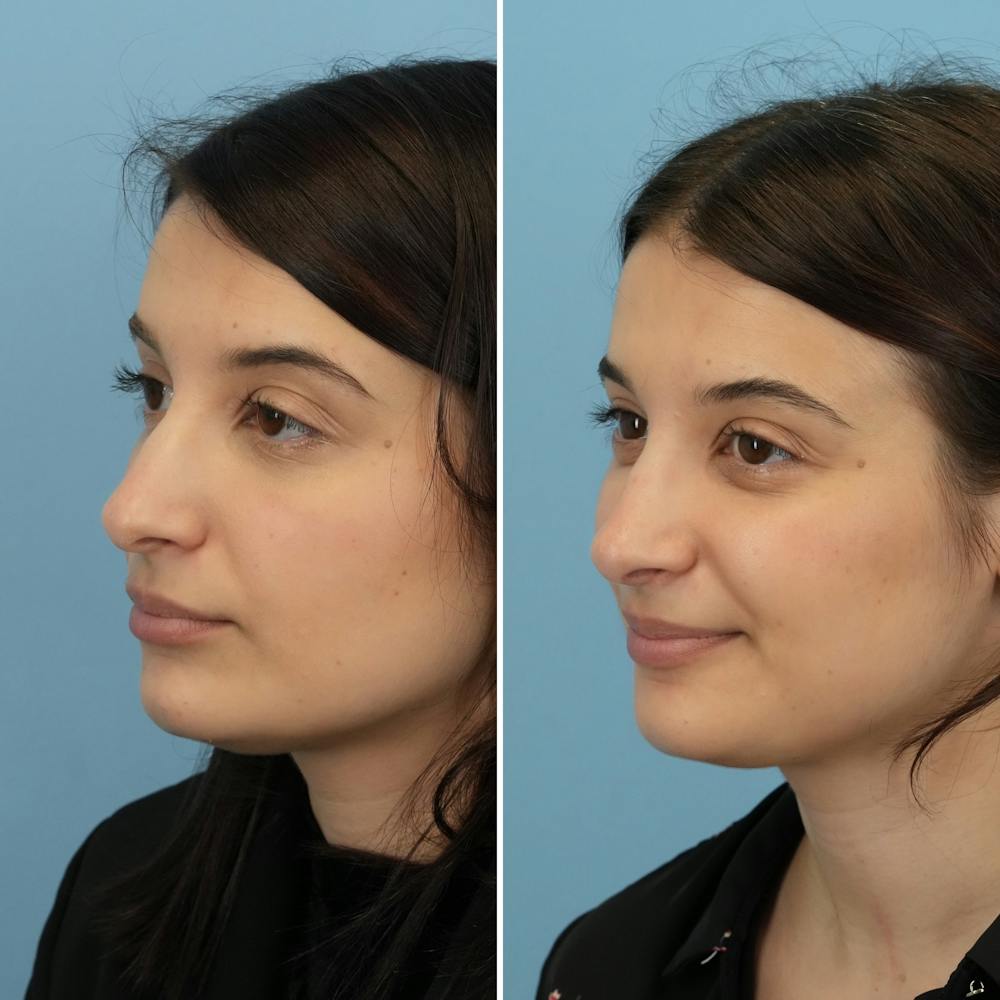 Rhinoplasty Before & After Gallery - Patient 312627 - Image 5