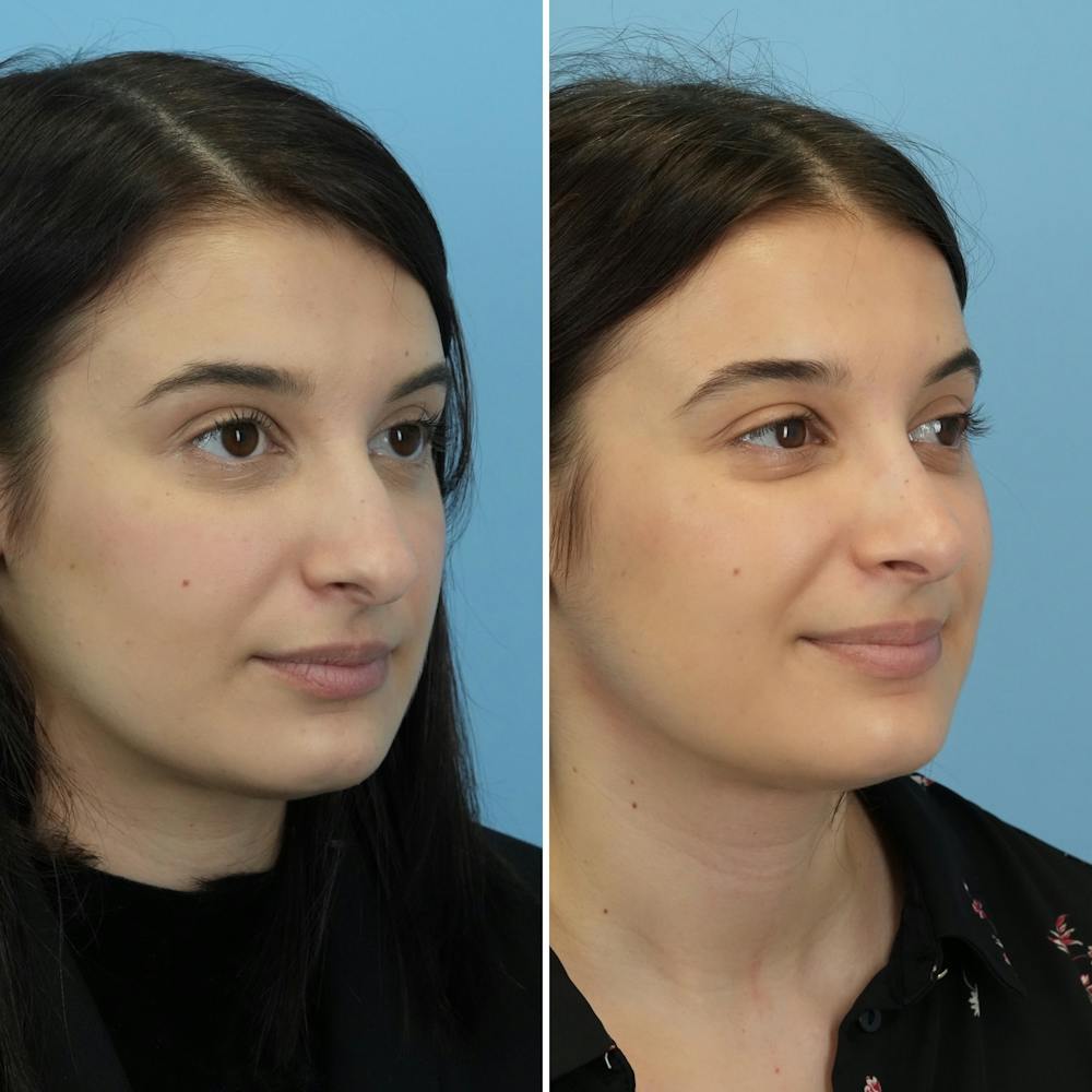 Rhinoplasty Before & After Gallery - Patient 312627 - Image 3